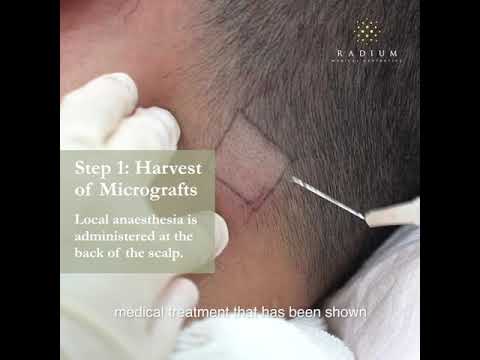 Regenera Activa - 头发疗程 @ REGENSIFY Clinic